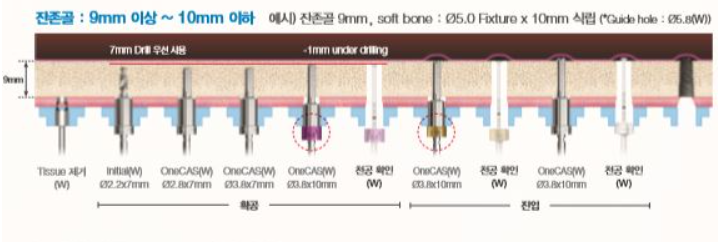잔존골 9mm이상 10mm 미만